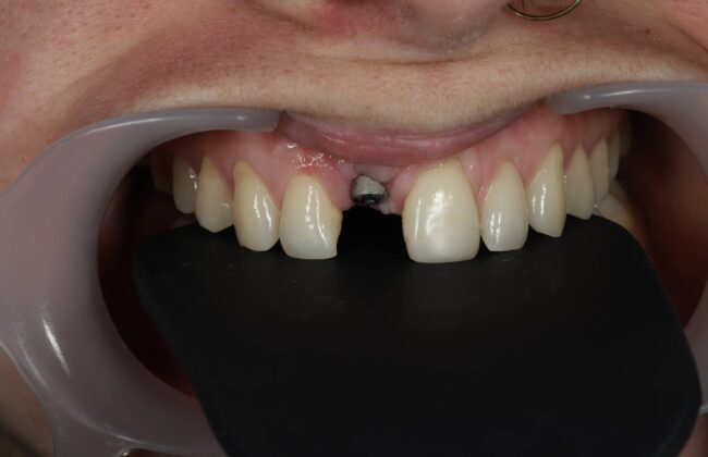 Before (Teeth)