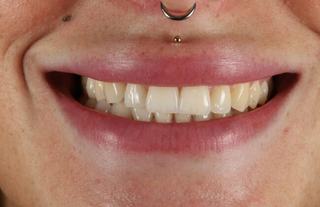 After (Teeth)