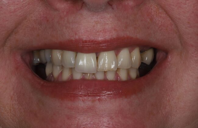 Before (Teeth)