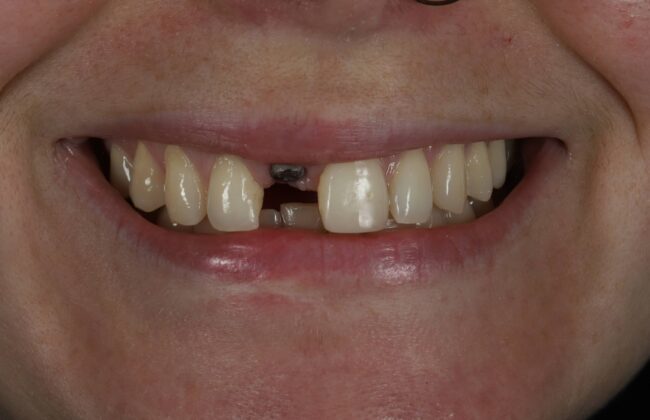 Before (Teeth)