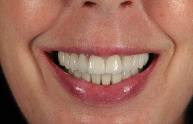 After (Teeth)