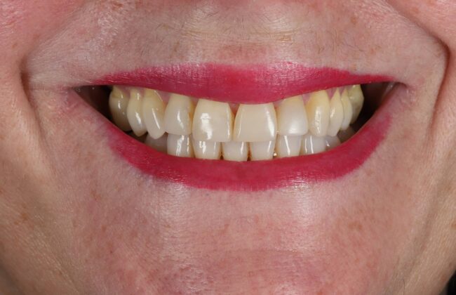 After (Teeth)