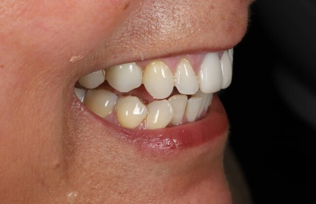 After (Teeth)