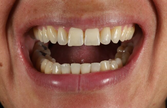 After (Teeth)