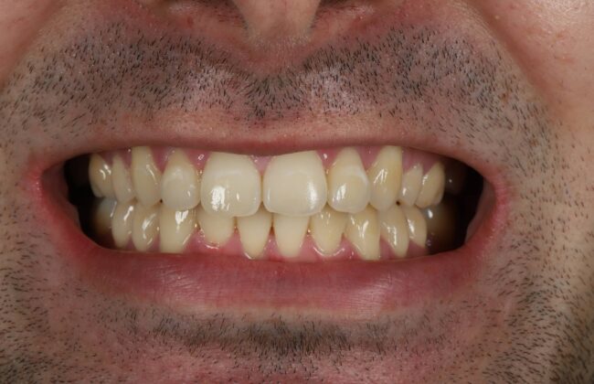 After (Teeth)