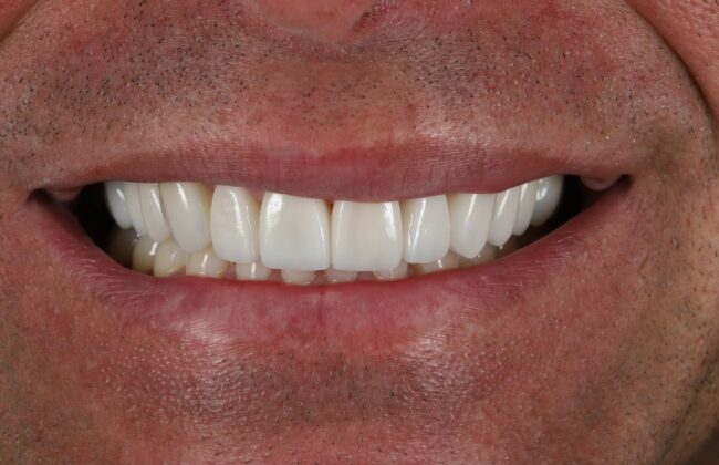 After (Teeth)