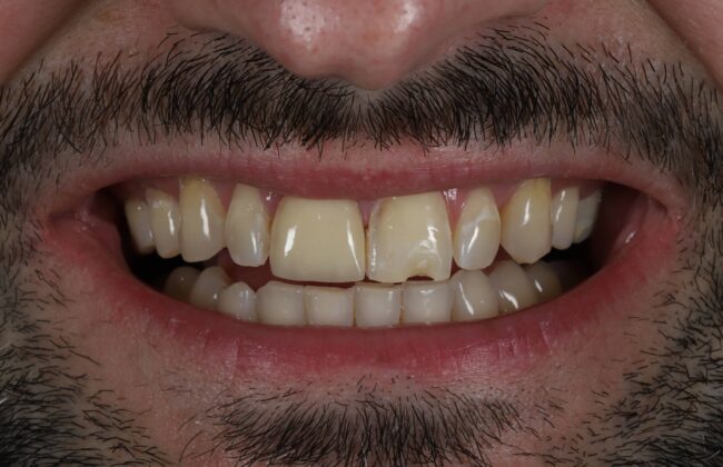 Before (Teeth)