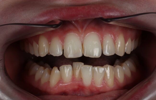 Before (Teeth)