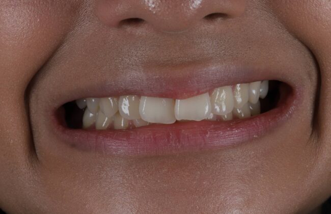 Before (Teeth)