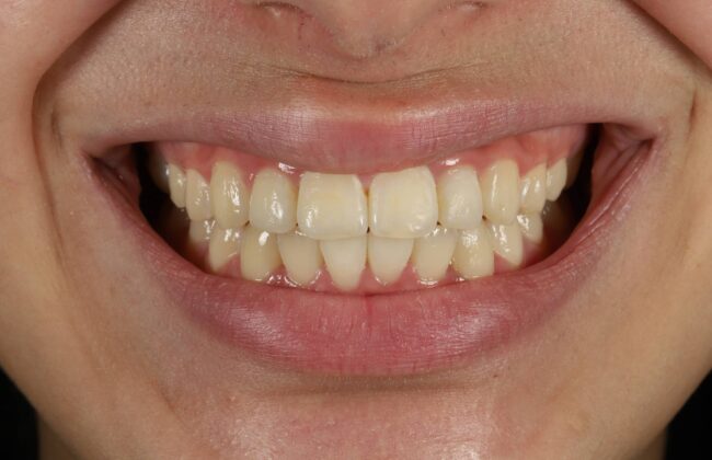 After (Teeth)
