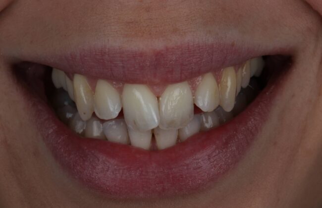 Before (Teeth)
