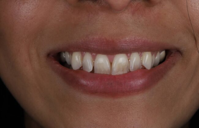 Before (Teeth)