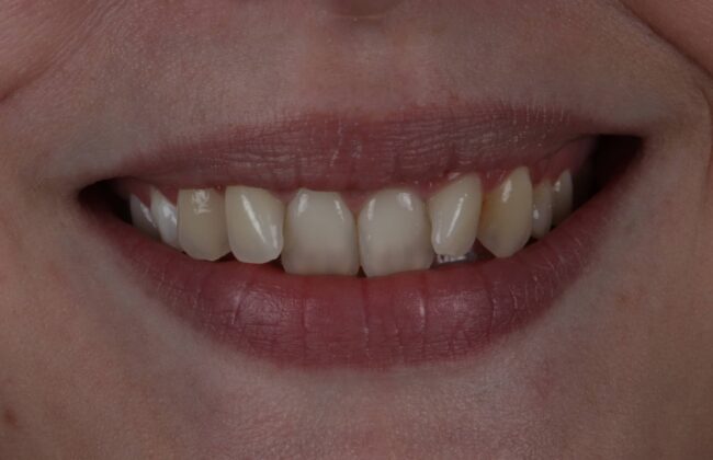Before (Teeth)