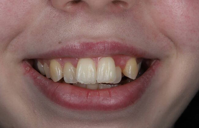 Before (Teeth)