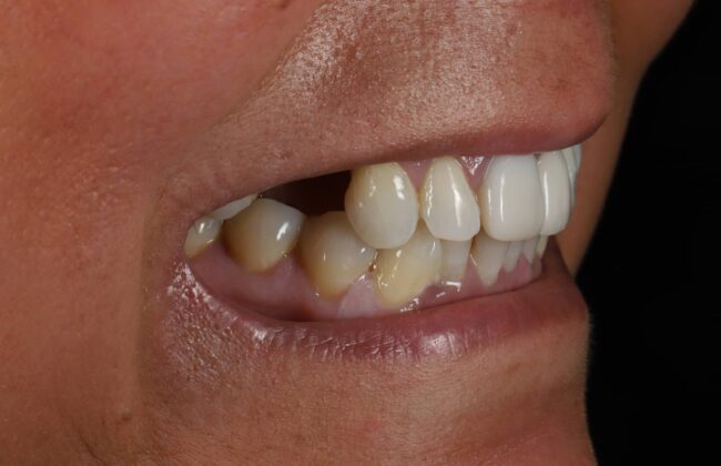 Before (Teeth)
