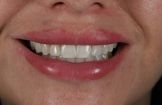 After (Teeth)