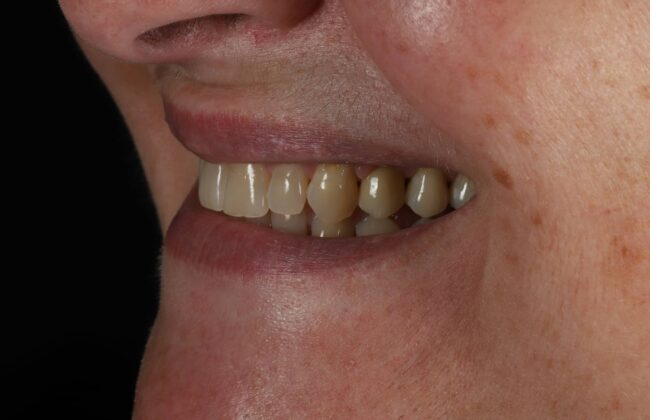 After (Teeth)