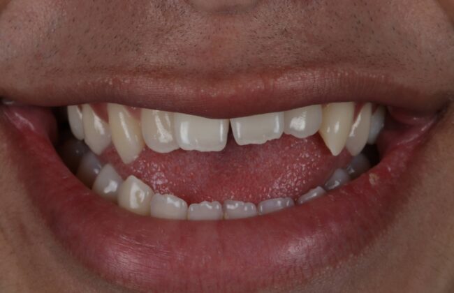Before (Teeth)