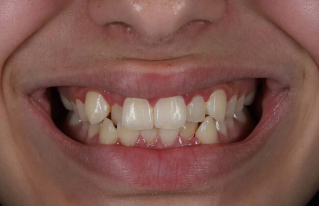 Before (Teeth)