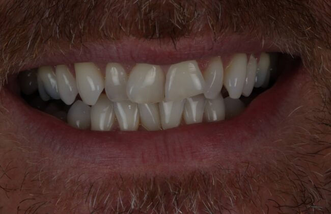 Before (Teeth)