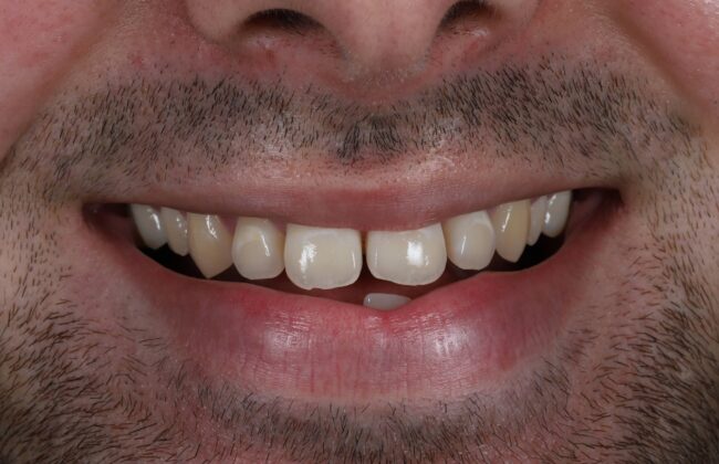 Before (Teeth)
