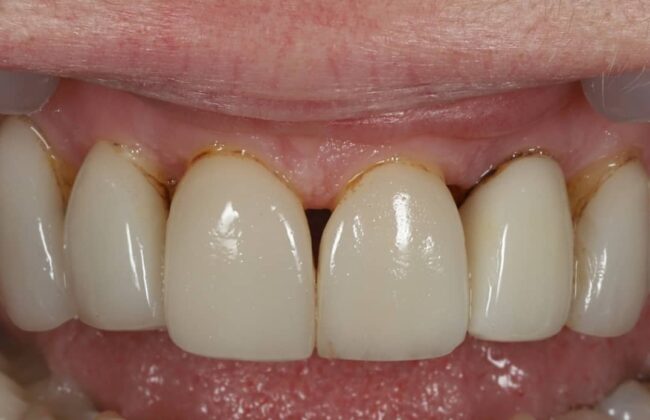Before (Teeth)