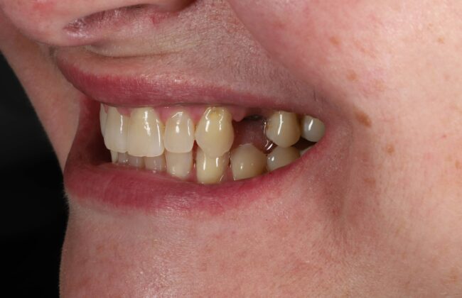 Before (Teeth)