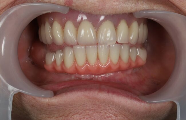 After (Teeth)