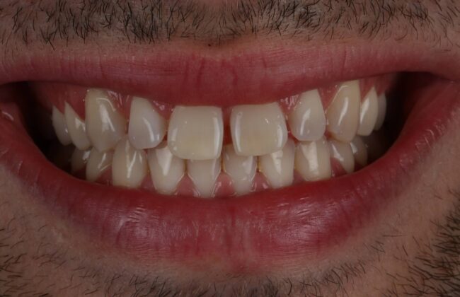 Before (Teeth)