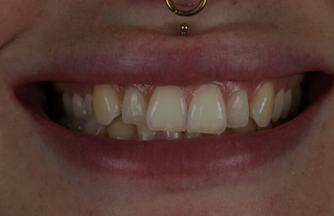 Before (Teeth)