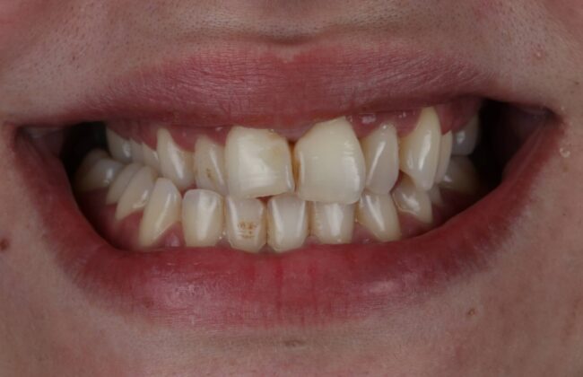 Before (Teeth)