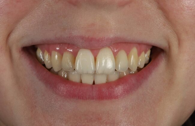 After (Teeth)