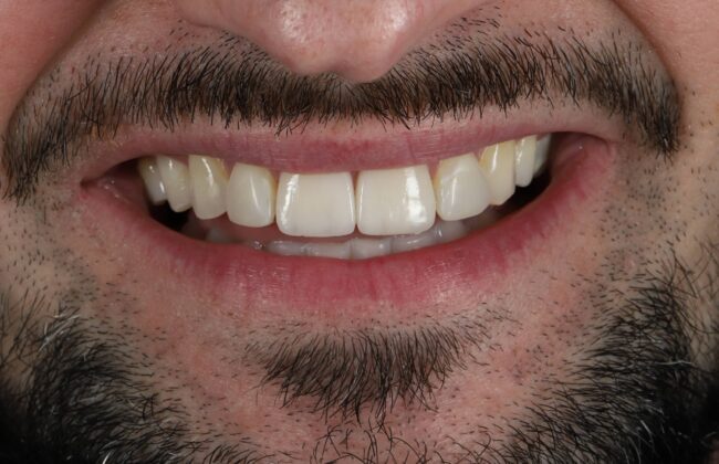 After (Teeth)