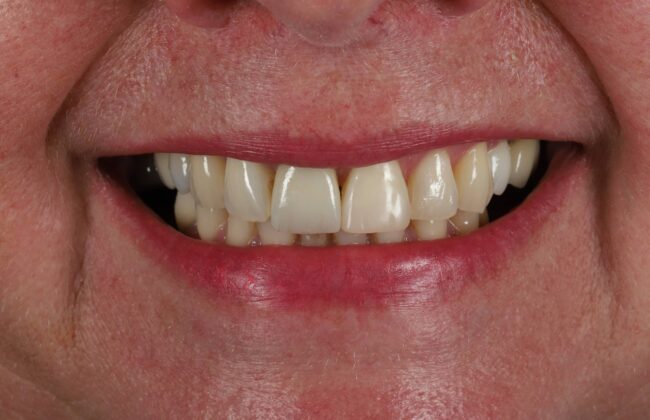 After (Teeth)
