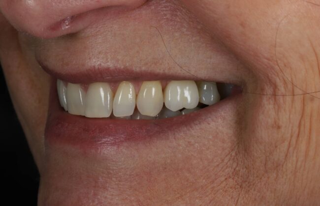 After (Teeth)