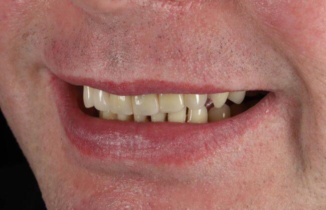 After (Teeth)