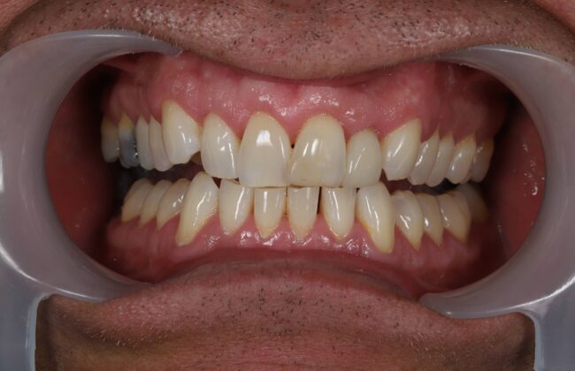 Before (Teeth)