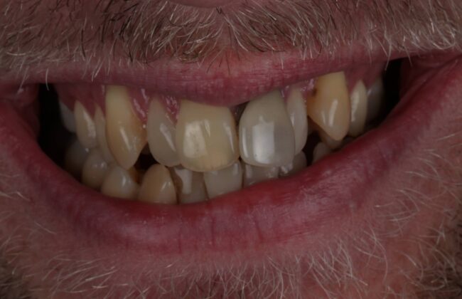 Before (Teeth)