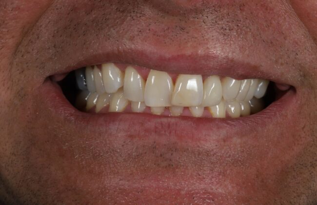 Before (Teeth)