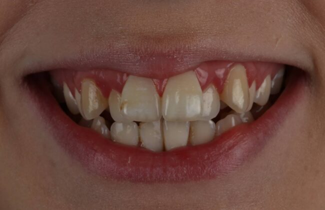 Before (Teeth)