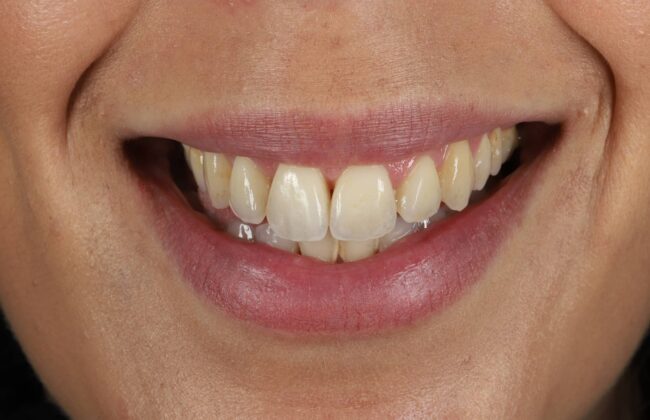 After (Teeth)