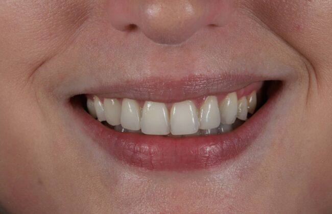 After (Teeth)