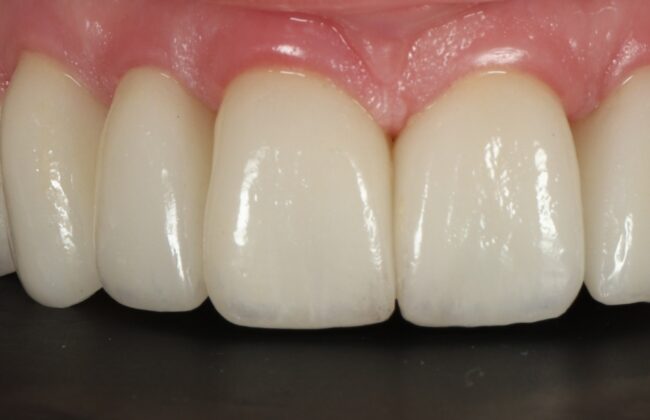 After (Teeth)