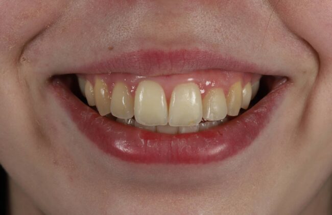 After (Teeth)