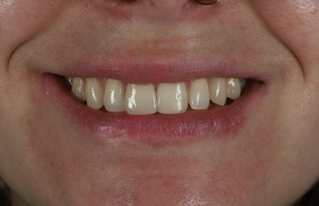 After (Teeth)