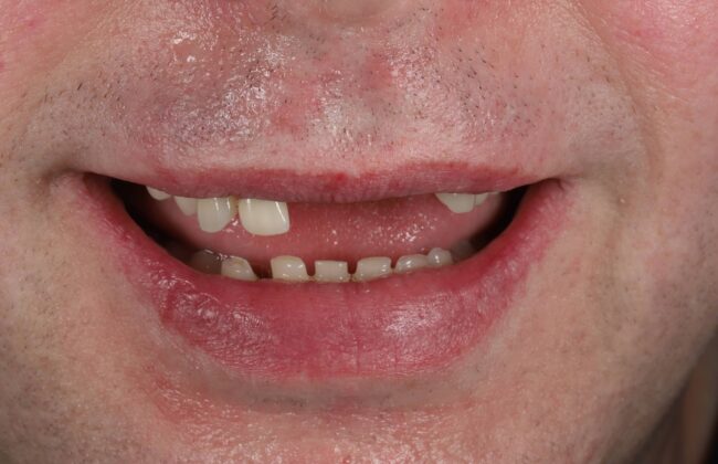 Before (Teeth)