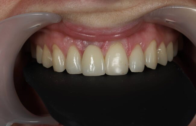 After (Teeth)