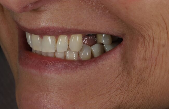 Before (Teeth)