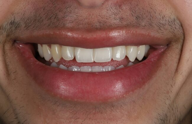After (Teeth)