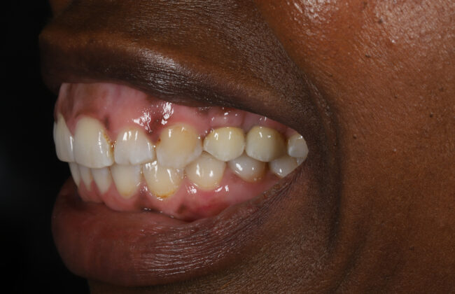 After (Teeth)
